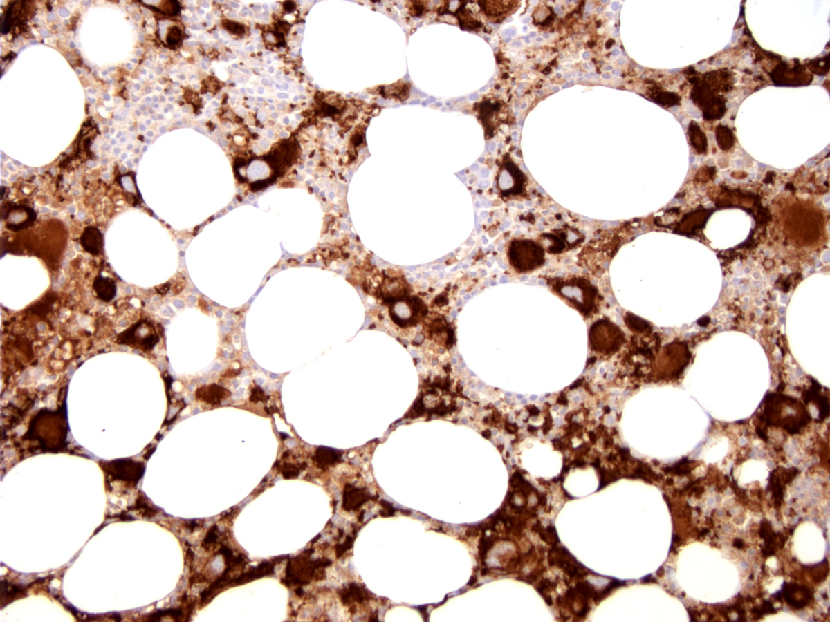 Bone marrow core biopsy section (BM-1), CD42b immunoperoxidase stain, x200